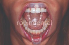 UMBRELLA CHEEK RETRACTOR 5PK