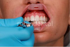 UMBRELLA CHEEK RETRACTOR 5PK