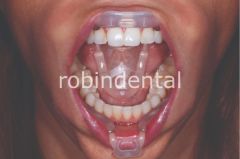 UMBRELLA CHEEK RETRACTOR 20PK