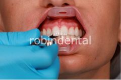 UMBRELLA CHEEK RETRACTOR 20PK