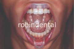 UMBRELLA CHEEK RETRACTOR 40PK